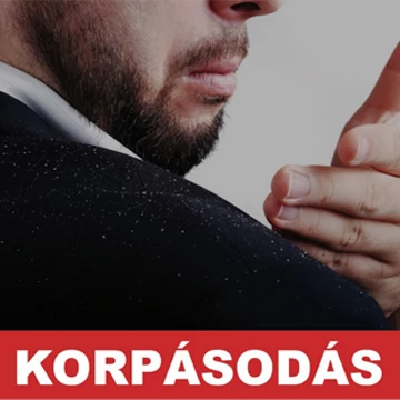 Vess véget a korpásodásnak!